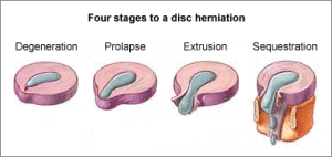 Disc Herniation Picture